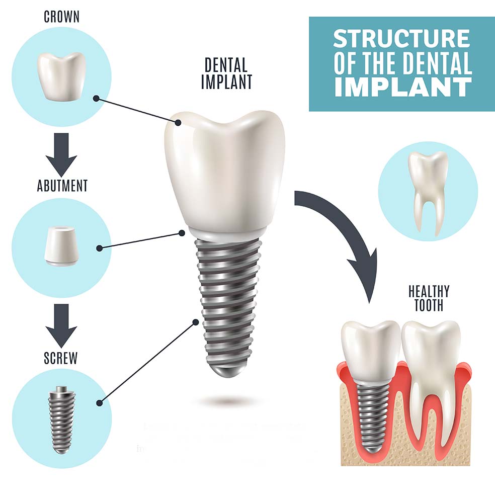 Dental Implants