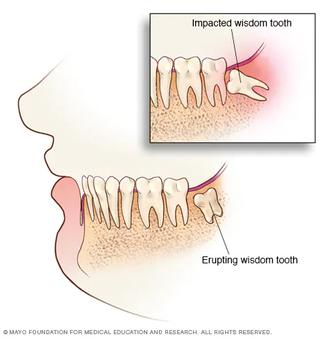 Wisdom Surgery